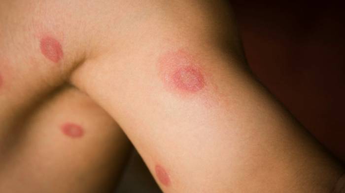 treat ringworm infection with Clotrimazole